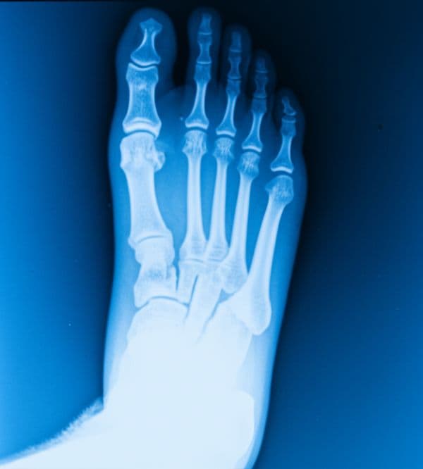 X-ray image of the bones of the foot