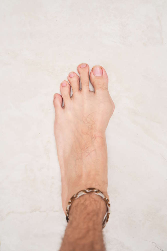 feet-of-a-patient-with-bunion-medical-condition
